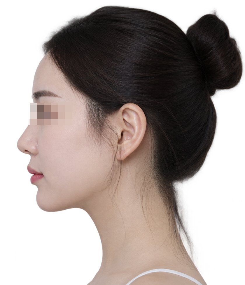 시술 후