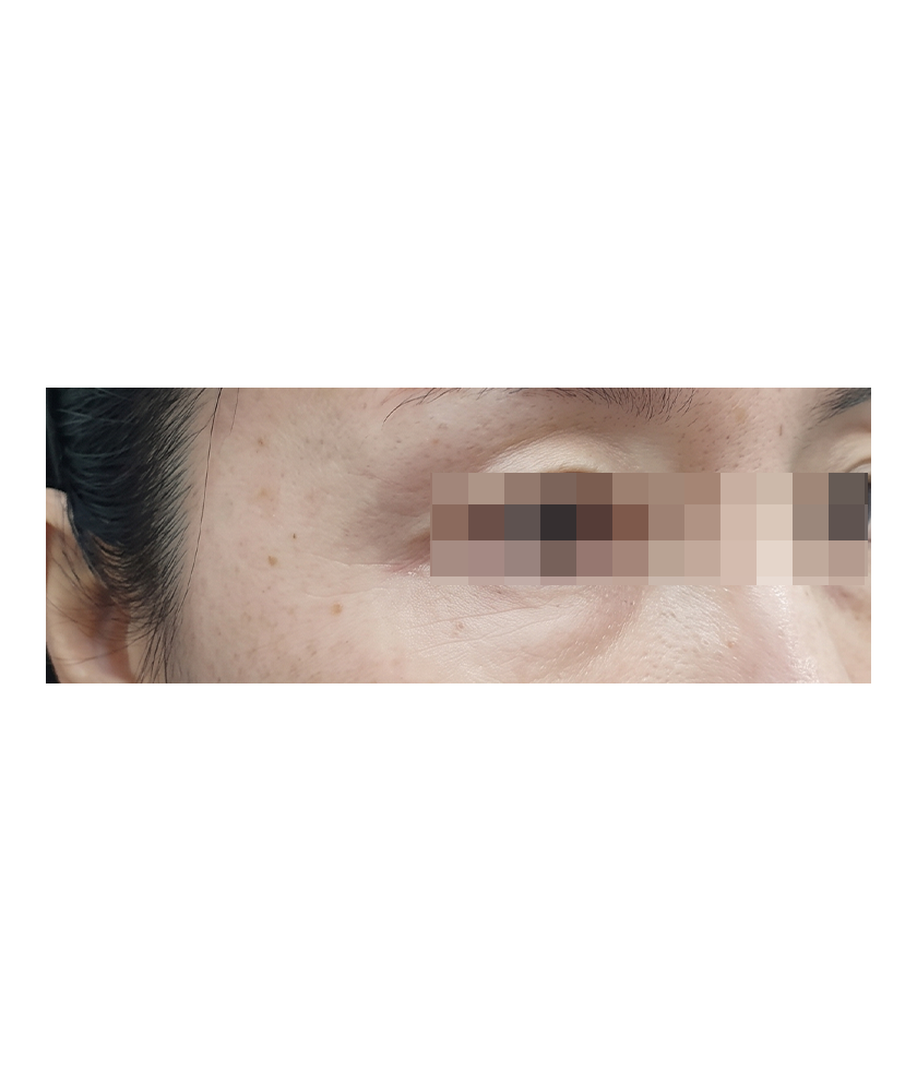 세르프 시술 후