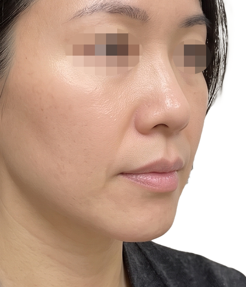 세르프 팔자주름 시술 후
