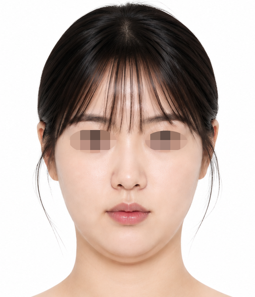 써마지 이중턱 시술 전
