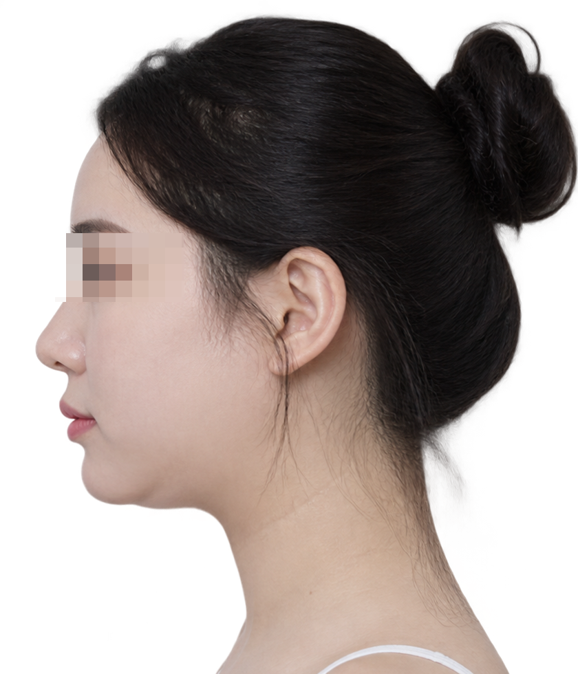 시술 전