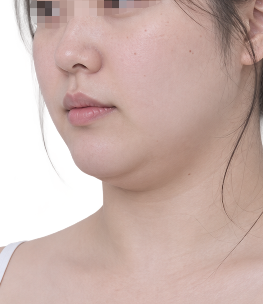 온다 리프팅 시술 전