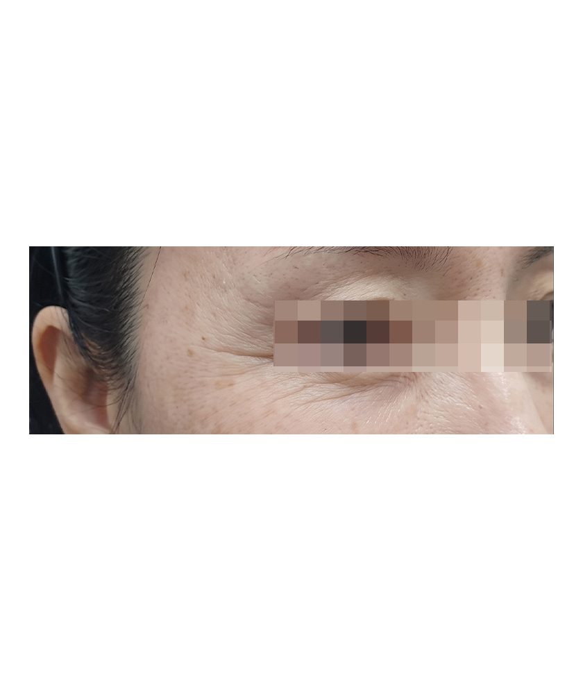 세르프 시술 전